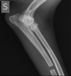DDUO (Dynamic Distal Ulnar Osteotomy) displasia del gomito
