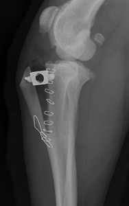Rottura del legamento crociato - MMT Radiografia eseguita nel postoperatorio.