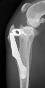 Rottura del legamento crociato - TTA. Radiografia eseguita a 30 gg dall'intervento.