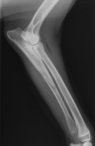 BOPDUO (Bi-Oblique Proximal Dynamic Ulnar Osteotomy) nella displasia del gomito