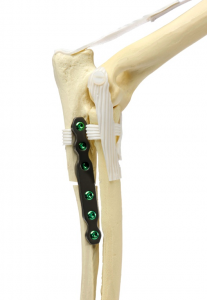 PAUL (Proximal Abducting Ulnar Osteotomy) nella displasia del gomito
