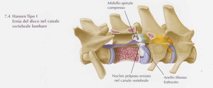 Ernia del disco Hansen tipo I nel canale vertebrale lombare